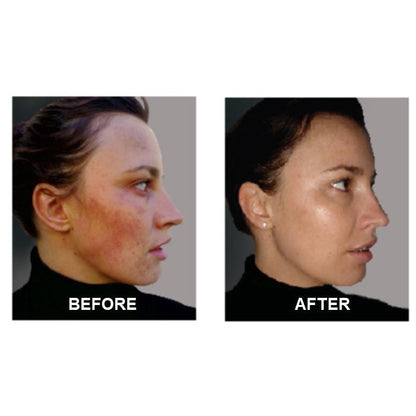 SkinSanity® Acne Treatment - Clear Skin Results Regimen